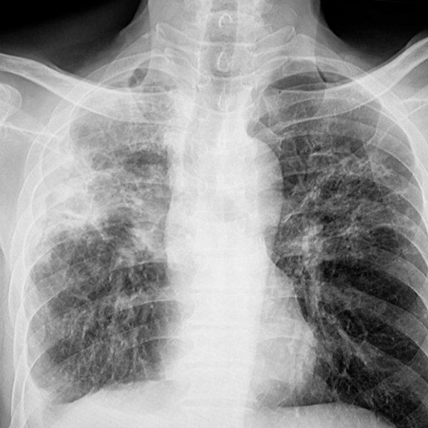 Don’t Ignore Persistent Cough, TB Specialist Warns