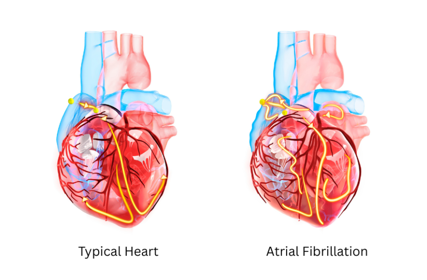 Atrial Fibrillation: Hidden Stroke Threat Affecting Malaysians